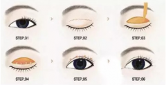 切开双眼皮手术可以改善哪些眼部问题呢?---北京京都医美整形